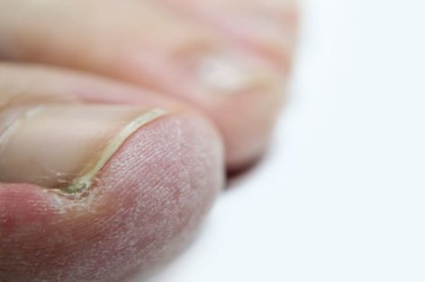Foto descascando a pele dos dedos em um fundo branco, seu artigo sobre cuidados com os pés